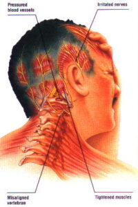 chiropractor for headaches